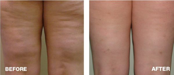 Velashape-result